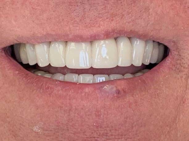 Photo of a patient after treatment at Prosthodontic Associates of Long Island 