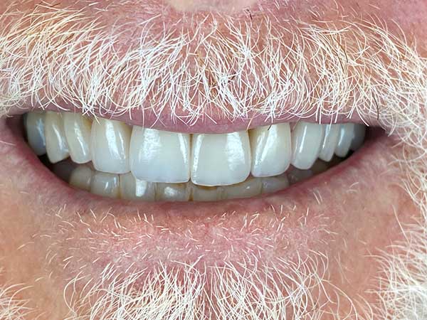 Photo of a patient after treatment at Prosthodontic Associates of Long Island 