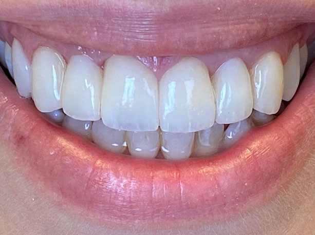 Photo of a patient after treatment at Prosthodontic Associates of Long Island 