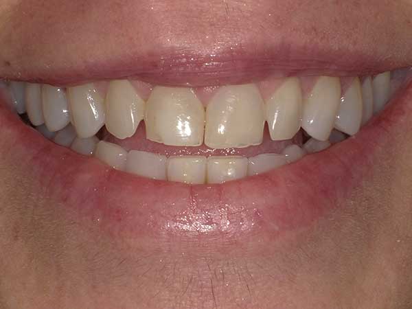 Photo of a patient before treatment at Prosthodontic Associates of Long Island 