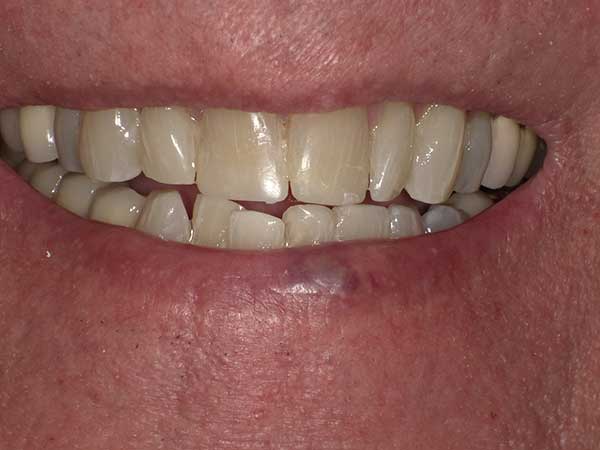 Photo of a patient before treatment at Prosthodontic Associates of Long Island 