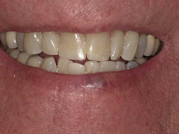 Photo of a patient before treatment at Prosthodontic Associates of Long Island 