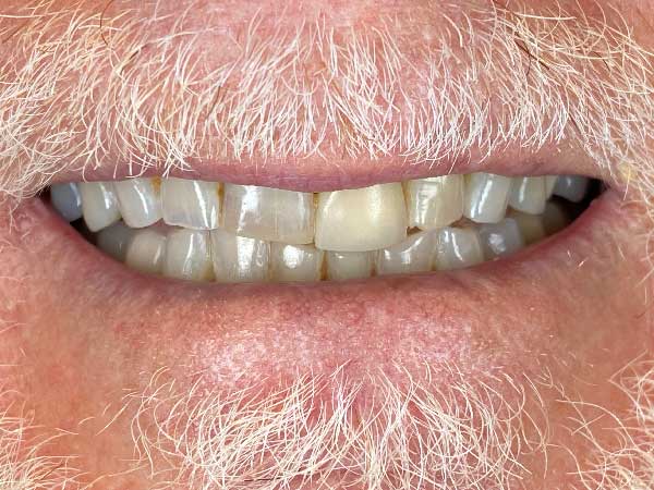 Photo of a patient before treatment at Prosthodontic Associates of Long Island 