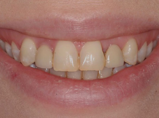 Photo of a patient before treatment at Prosthodontic Associates of Long Island 