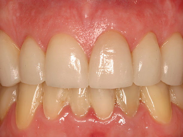 Photo of a patient after treatment at Prosthodontic Associates of Long Island 