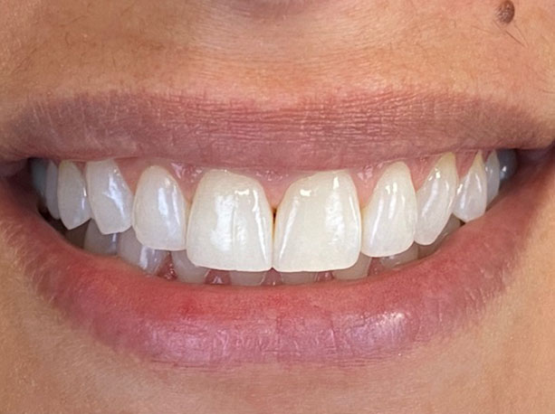 Photo of a patient after treatment at Prosthodontic Associates of Long Island 