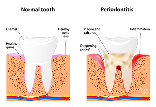 Illustration of a tooth with periodontal disease, in need of scaling and root planing, at dentist office in Lake Success, NY.